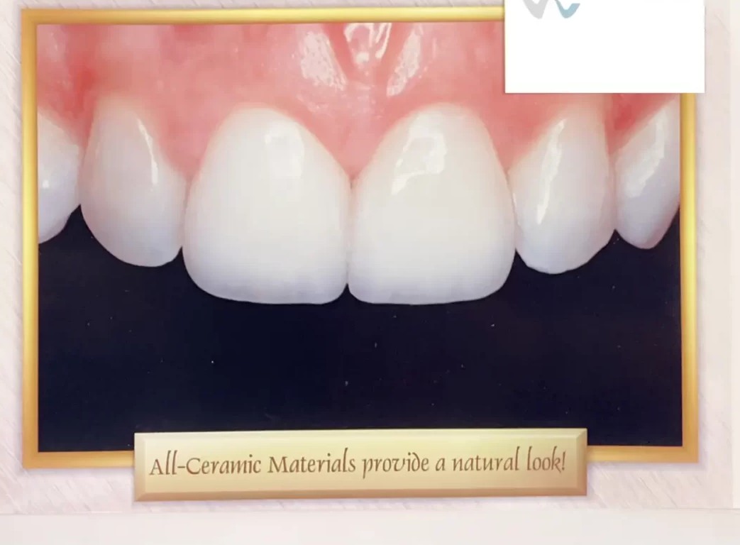 All-Ceramic Crown / Veneer — After
