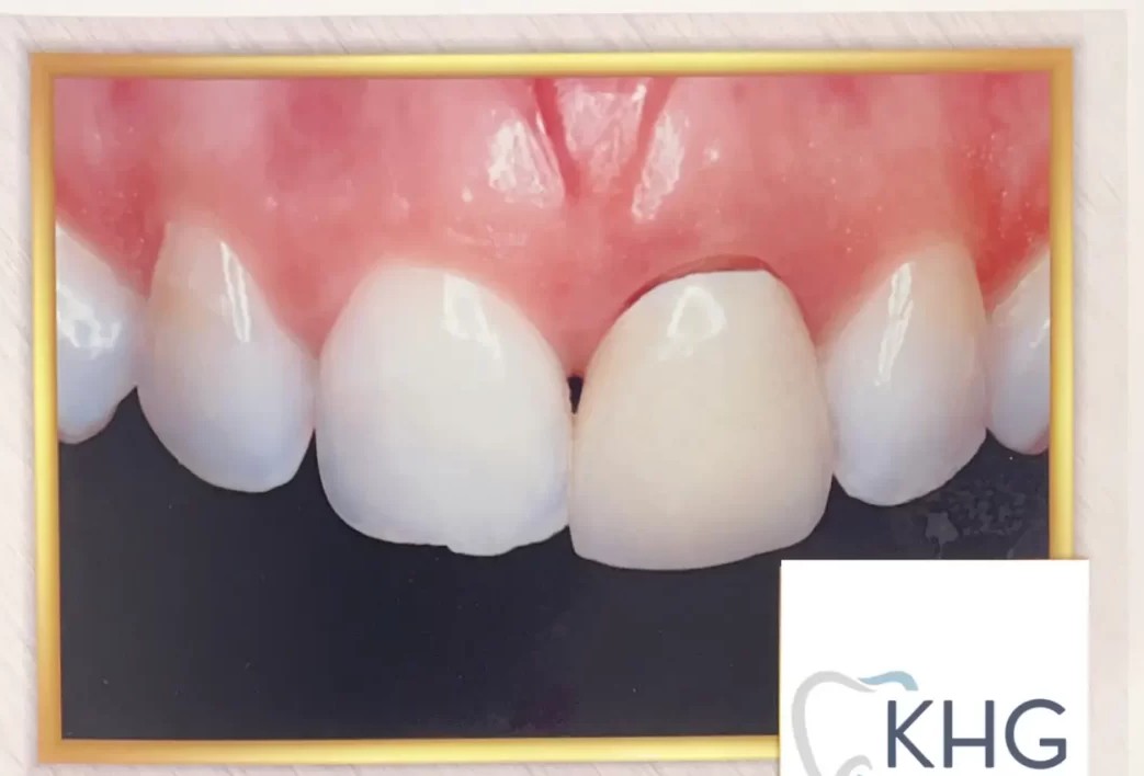 All-Ceramic Crown / Veneer — Before